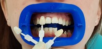 Отбеливание зубов  Zoom4, врач Кутыркина Юлия Валерьевна